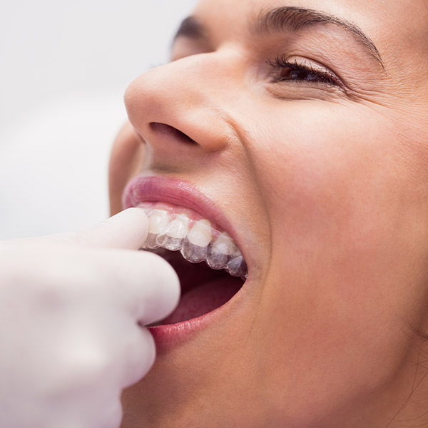 Ortodoncia Invisible