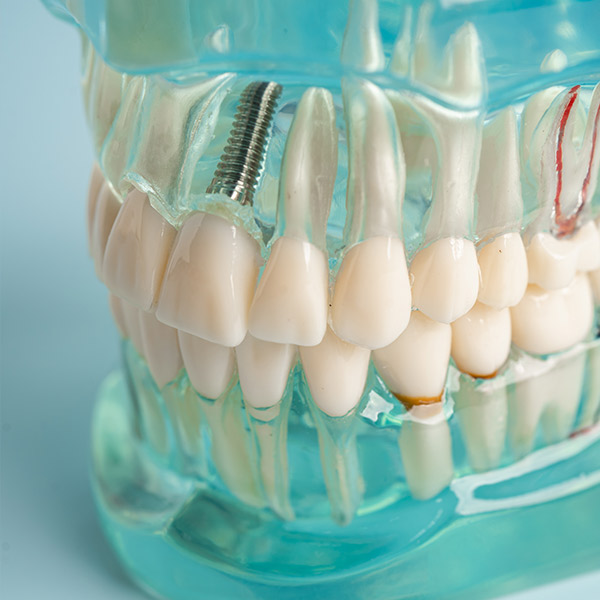 Prótesis fijas sobre dientes o implantes